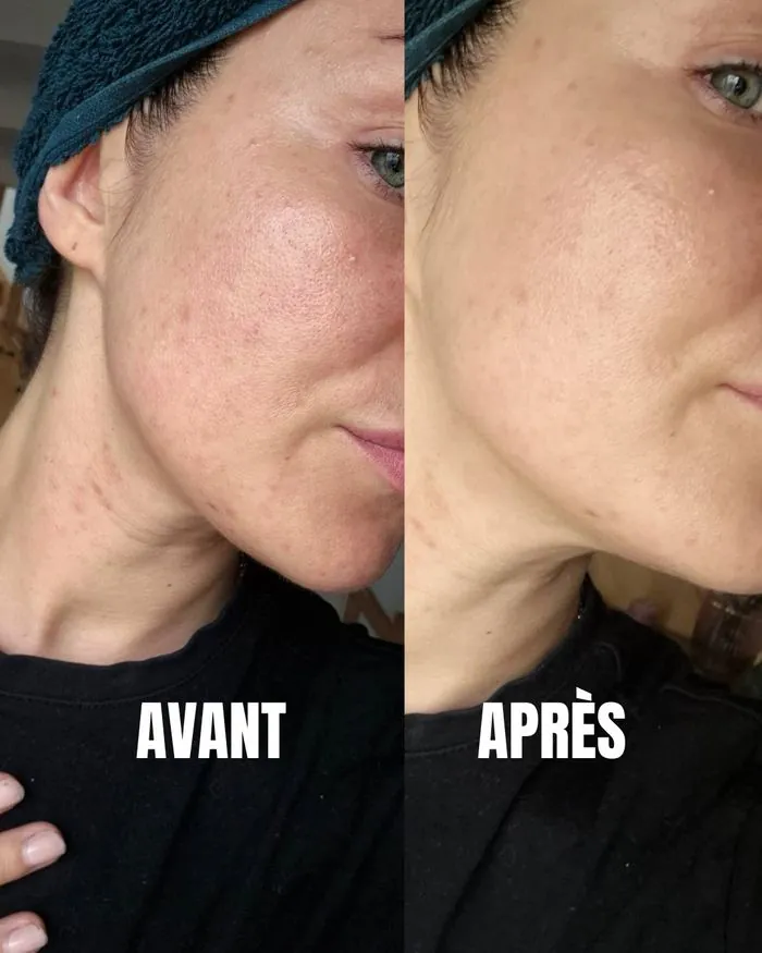 Résultat acné