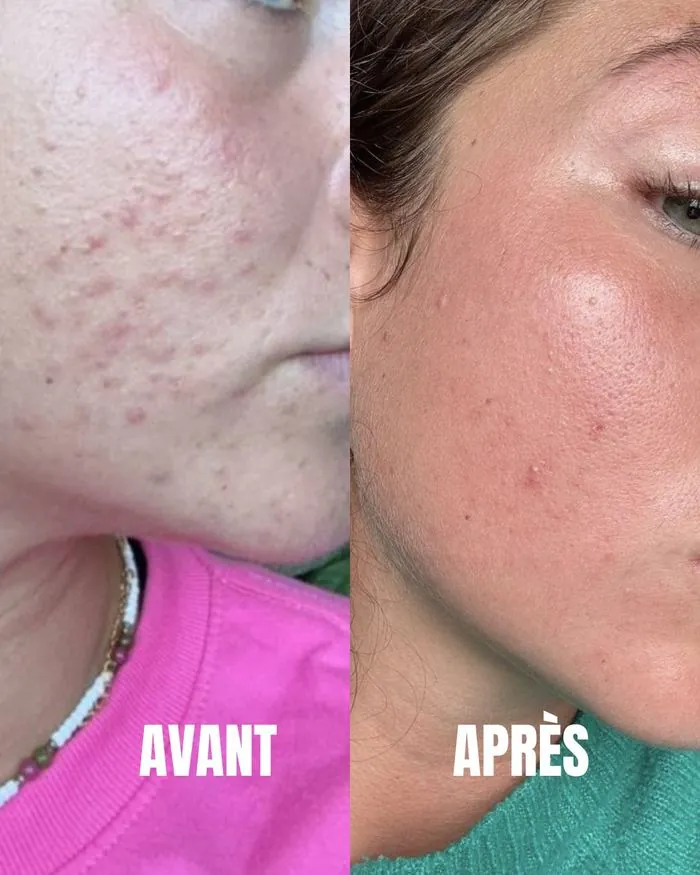 Résultat acné