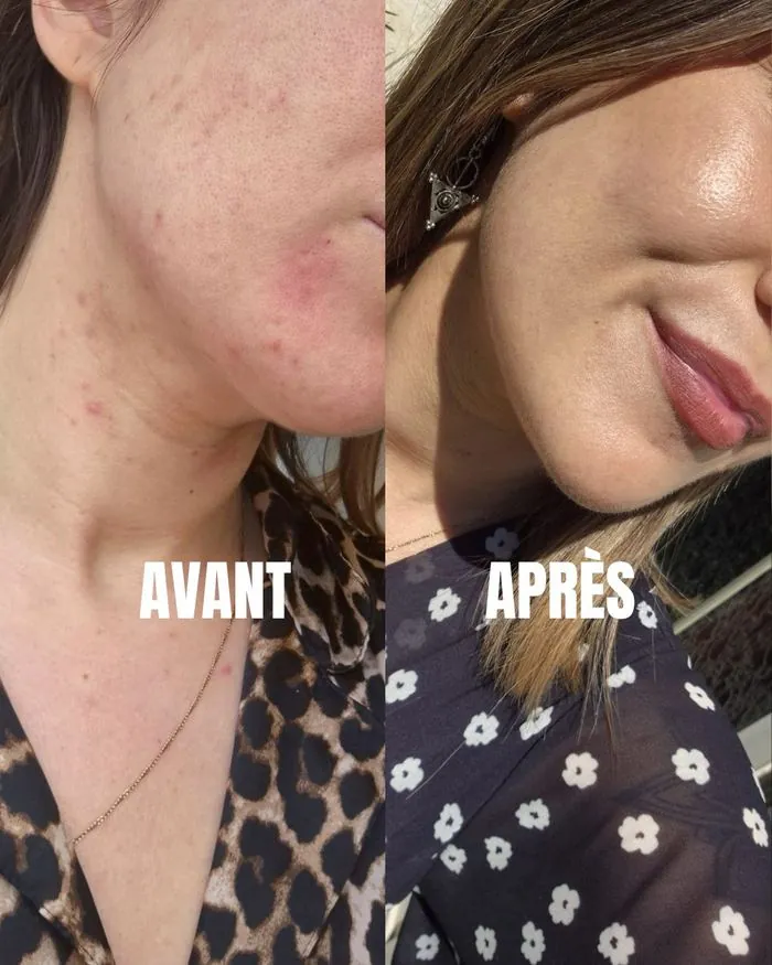 Résultat acné